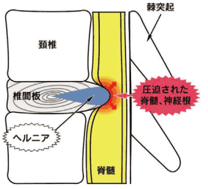 ヘルニア図