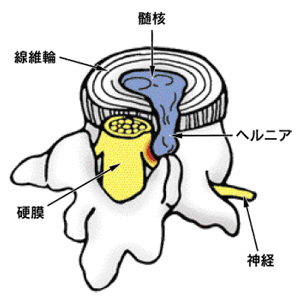 ヘルニア図