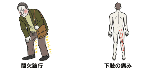 間欠跛行・下肢の痛み