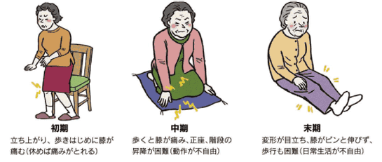 変形性膝関節症