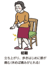 変形性膝関節症