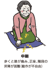 変形性膝関節症