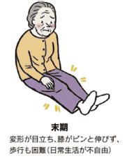 変形性膝関節症